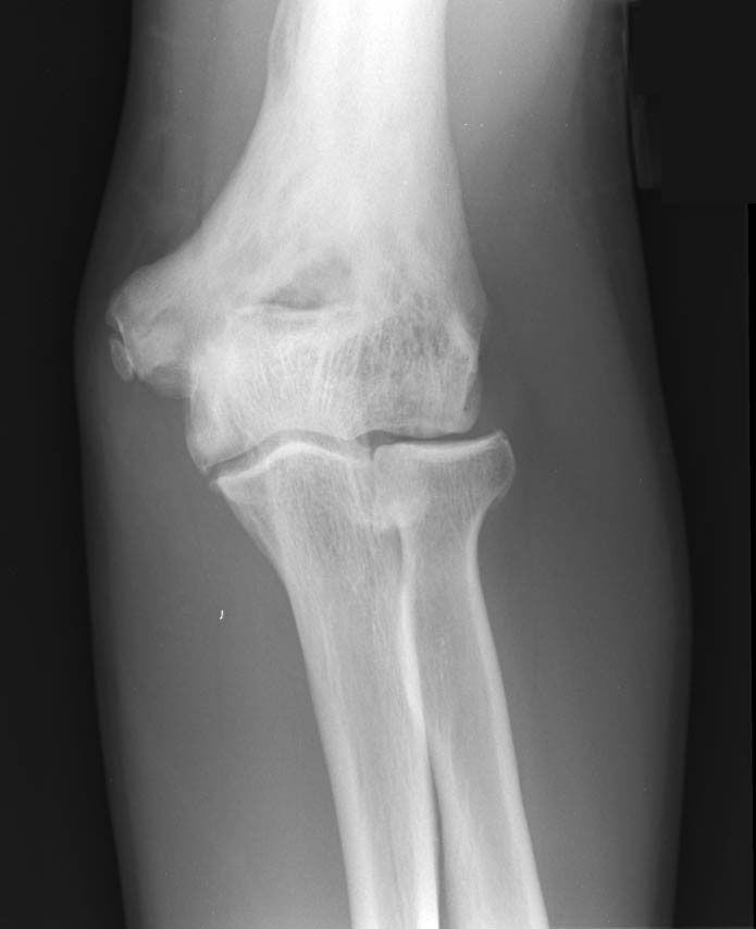 09 Older Adult Elbow Pain | BoneTumor.org