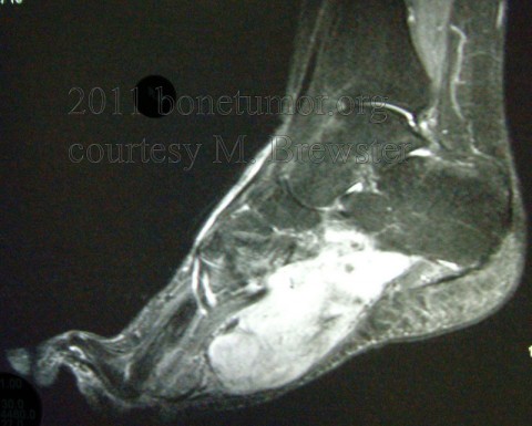 Synovial sarcoma - Foot and Ankle | BoneTumor.org