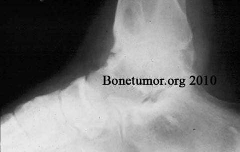 pigmented villonodular synovitis - foot and ankle | BoneTumor.org