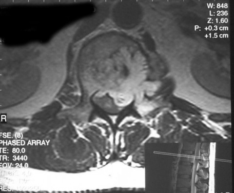 Chordoma of the lumbar spine - MR 2 | BoneTumor.org