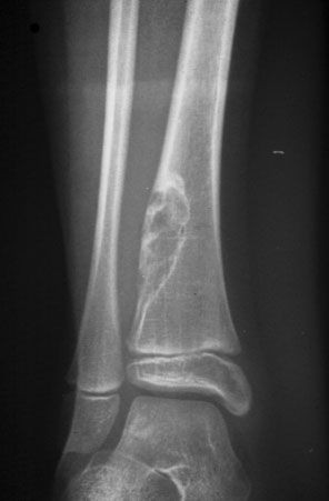 No Fibroma Osificante | BoneTumor.org