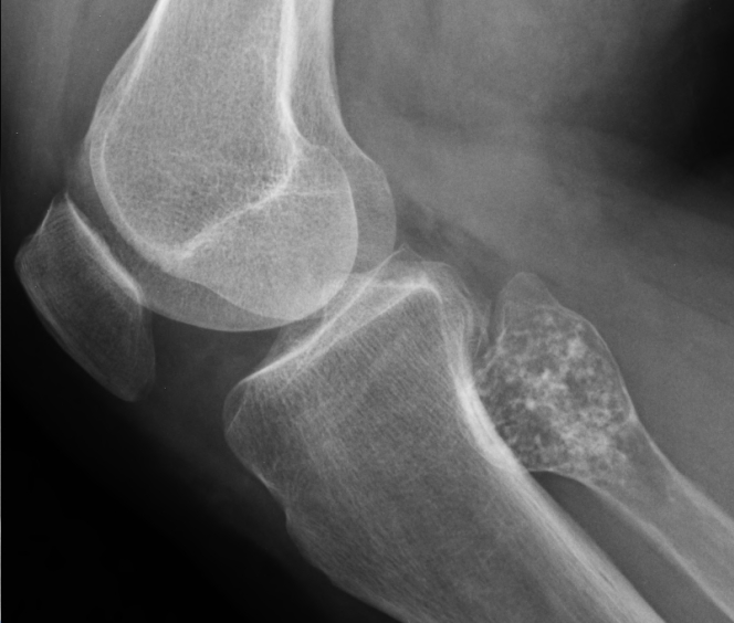 chondroma in knee x ray